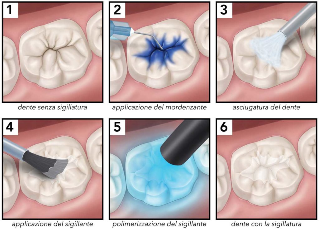 SFP Dental Service Versilia | SIGILLATURA MOLARI A MASSA